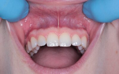 Implanty zębowe – koszty, ceny, korzyści